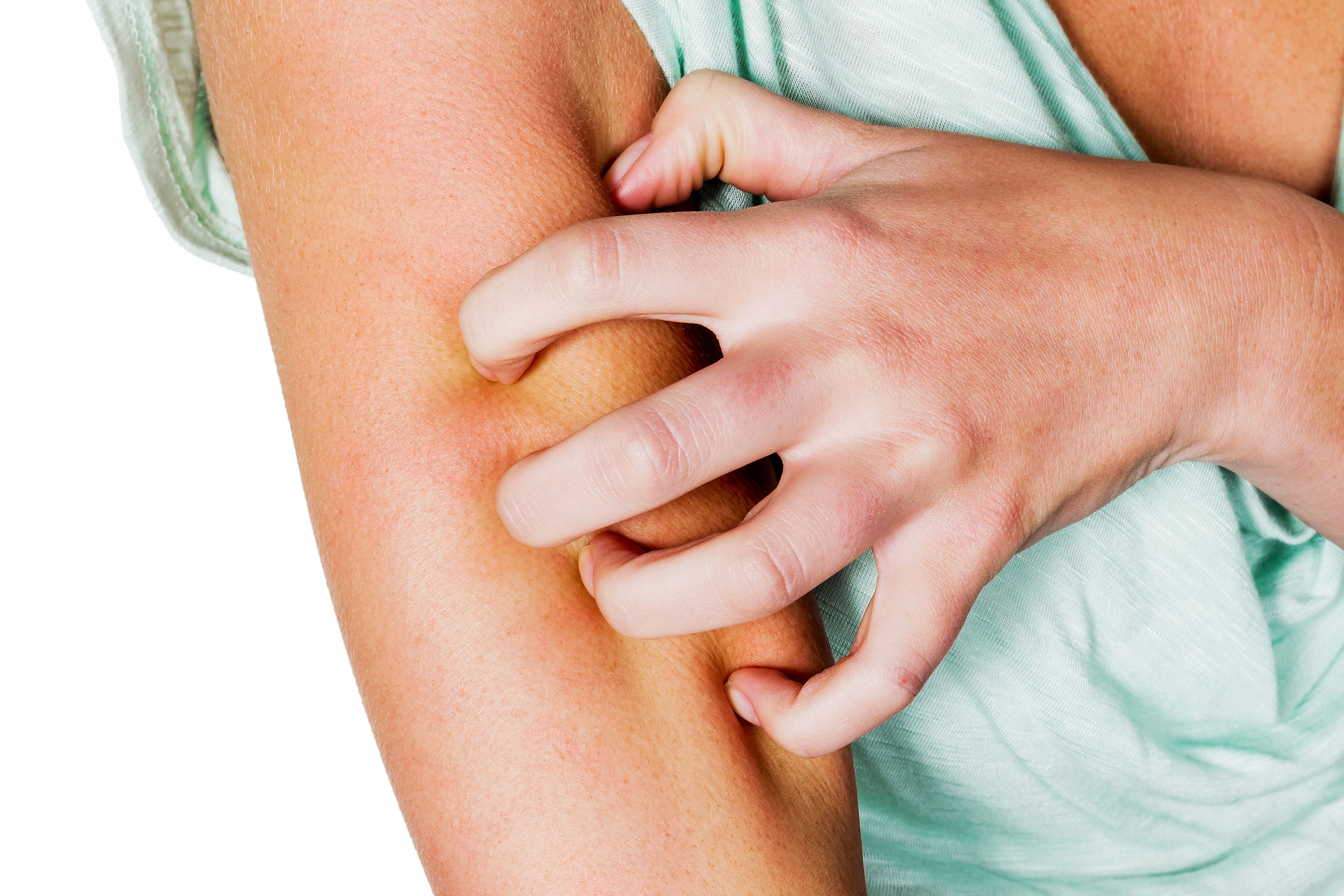 DERMATITIS