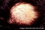 alopecia areata