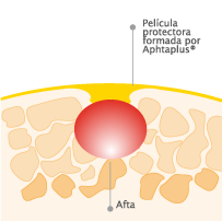 Para las aftas de la boca Aphtaplus.