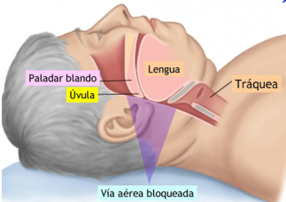 Apnea del sueño 03