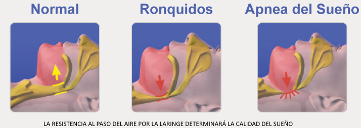 Apnea del sueño