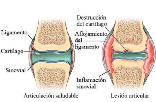 Artritis reumatoide