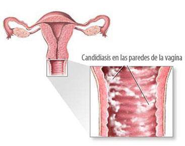 Candidiasis vaginal en verano