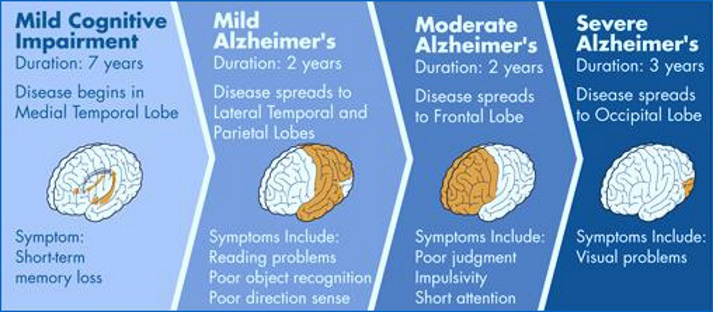 Porque adelgazan tanto los enfermos de alzheimer