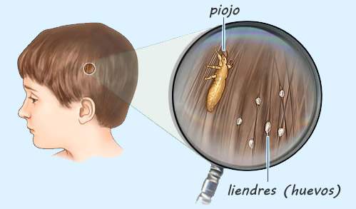 Vuestras 10 dudas más frecuentes sobre los piojos