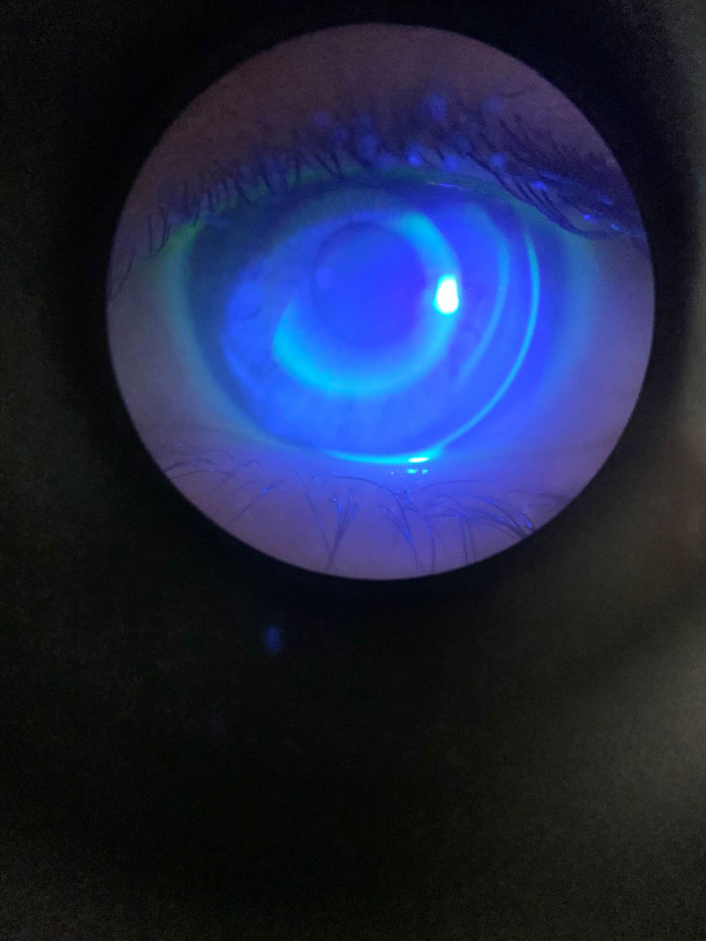 Imagen del ojo de la paciente durante el proceso de adaptación de las lentillas orto-k