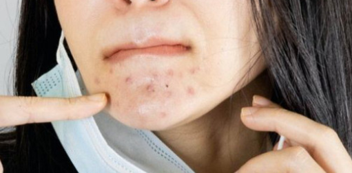 ACNE PER L'ÚS DE MASCARETES.