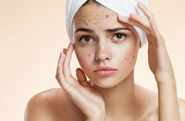 Campanya contra l'acne